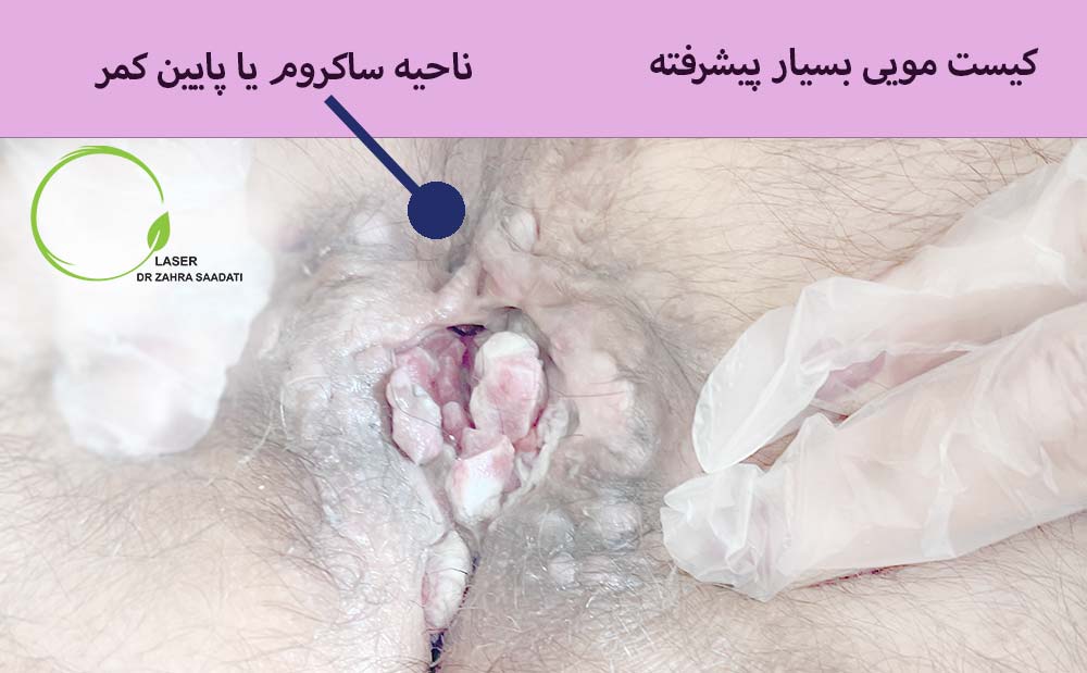 کیست مویی وخیم و پیشرفته که بر اثر عفونت شدید به بافت ناحیه آسیب وارد شده است