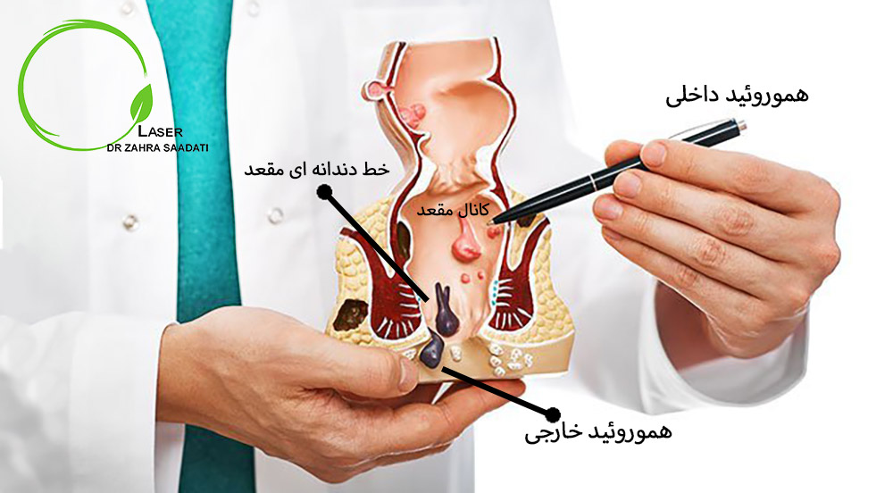 آناتومی هموروئید و تشخیص هموروئید داخلی و خارجی در کانال مقعد