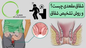 شقاق مقعدی چیست و روش تشخیص