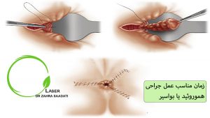 زمان مناسب جراحی هموروئید یا بواسیر