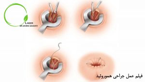 فیلم عمل جراحی هموروئید چگونه است