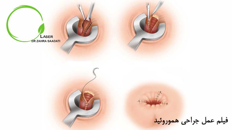 فیلم عمل جراحی هموروئید چگونه است