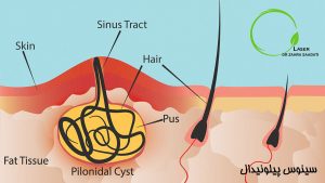 سینوس پیلونیدال