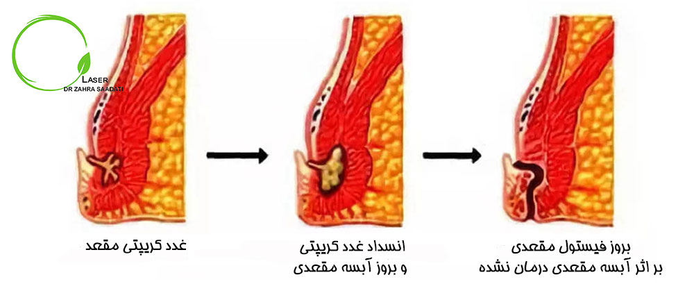 علت فیستول مقعدی