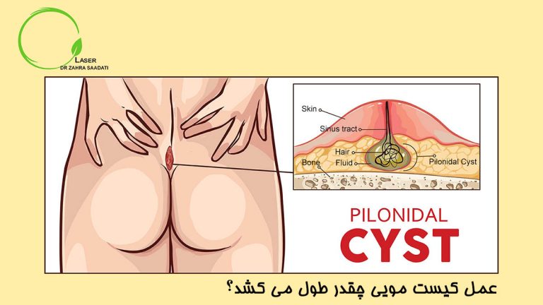 عمل کیست مویی چقدر طول میکشد