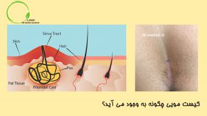 کیست مویی چگونه به وجود می آید