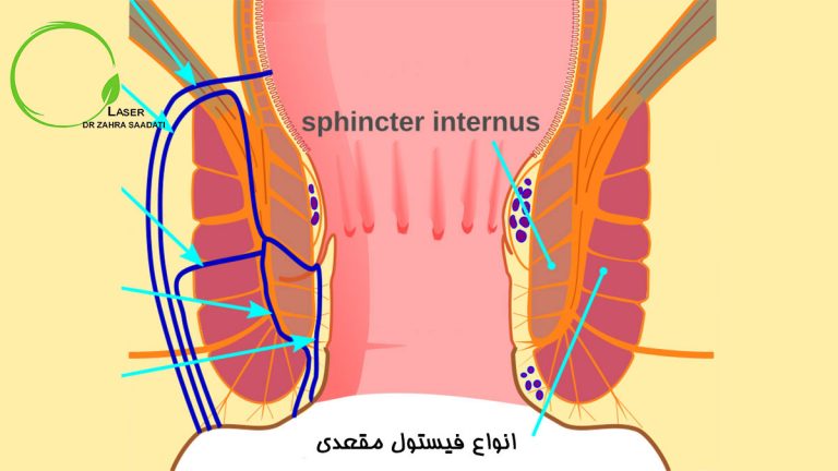 انواع فیستول مقعدی