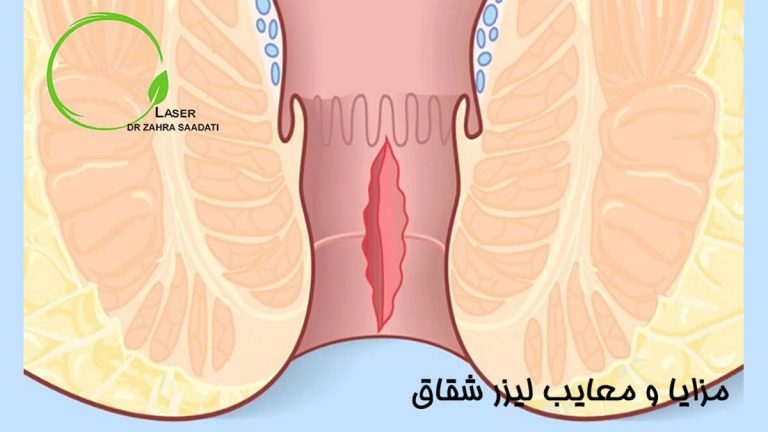 مزایا و معایب لیزر شقاق