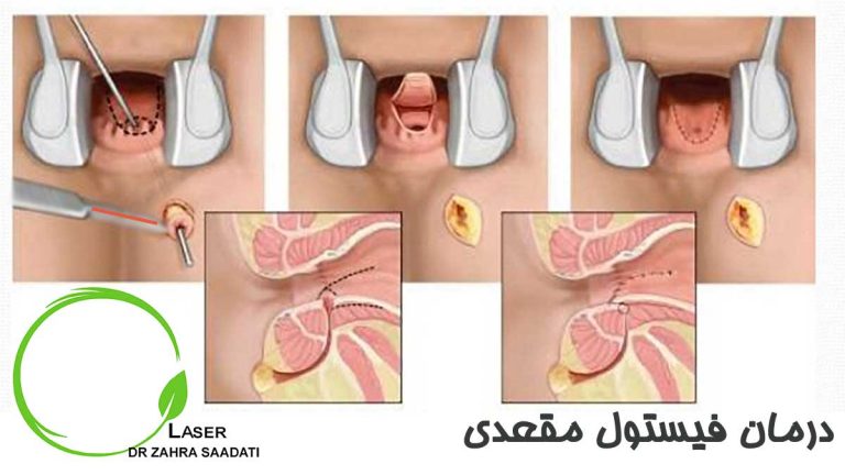 درمان فیستول مقعدی