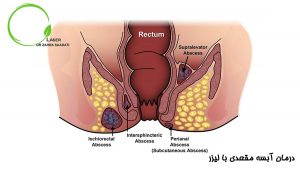 درمان آبسه مقعدی با لیزر