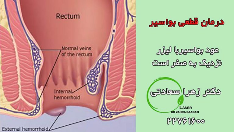 درمان اصلی بواسیر