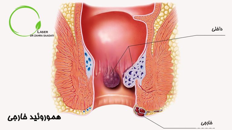 هموروئید خارجی