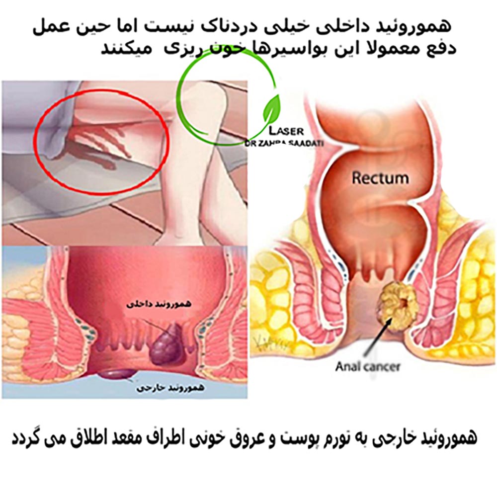 علائم هموروئید خارجی