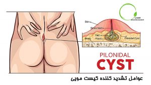 عوامل تشدید کننده کیست مویی