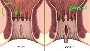 انواع شقاق