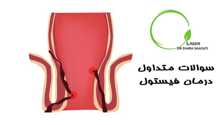 سوالات متداول درمان فیستول