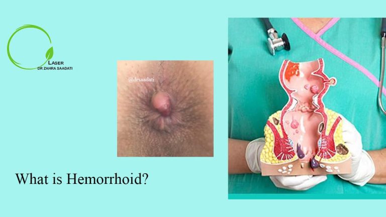 hemorrhoid