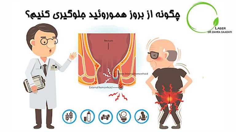 چطور از بروز هموروئید جلوگیری کنیم