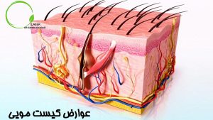 عوارض کیست مویی