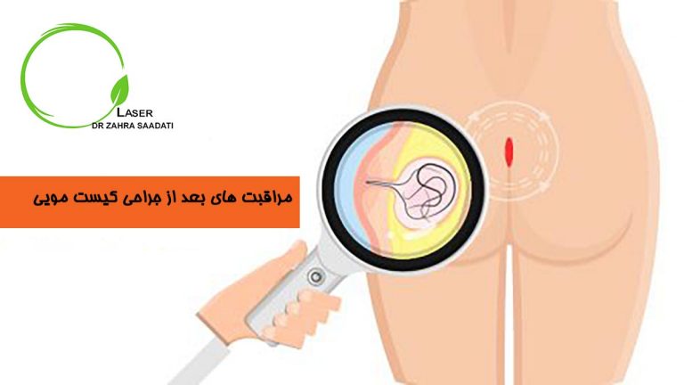 مراقبت های بعد از جراحی کیست مویی