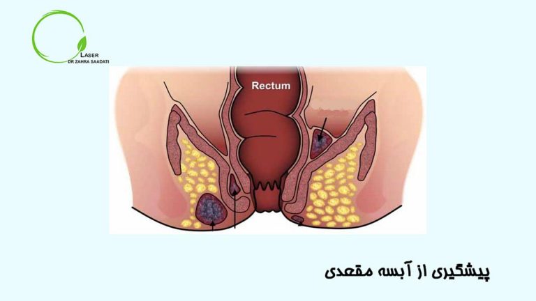 جلوگیری از آبسه مقعدی