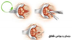 درمان و جراحی شقاق