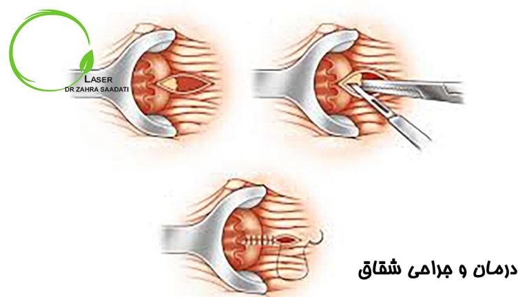 درمان و جراحی شقاق