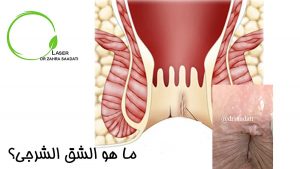 ما هو الشق الشرجي