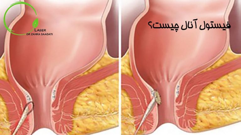 فیستول آنال چیست