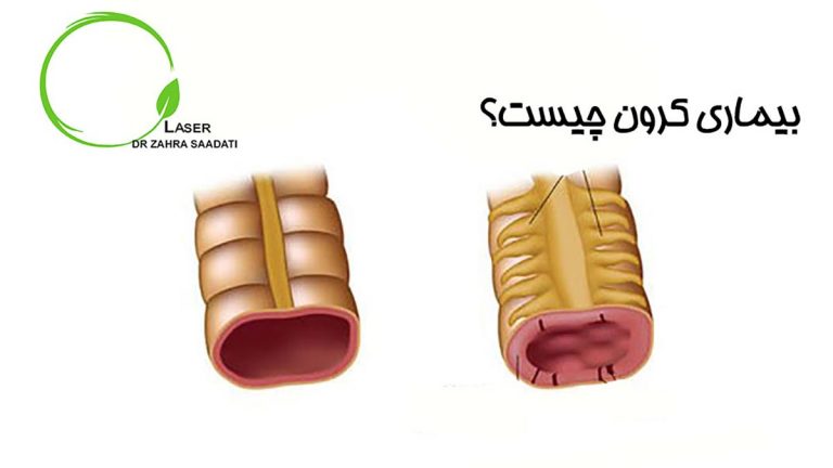 بیماری کرون چیست