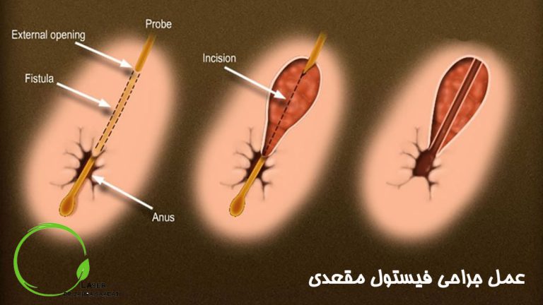 عمل جراحی فیستول مقعدی