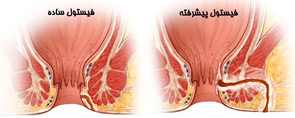 فیستول مقعدی پیشرفته و ساده