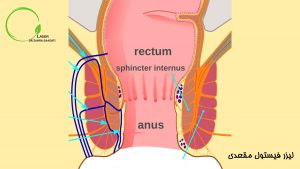 لیزر فیستول مقعدی