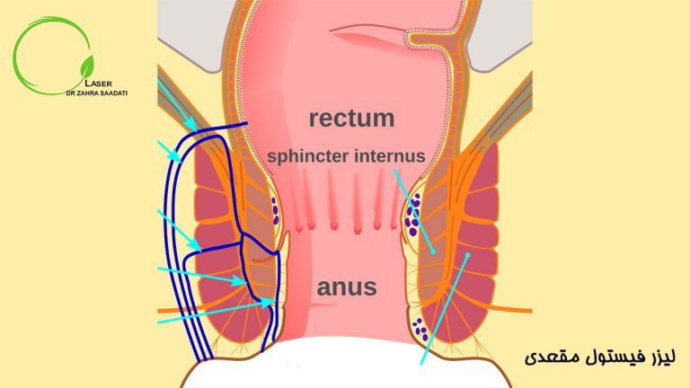 لیزر فیستول مقعدی