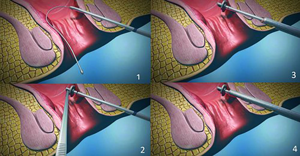 مراحل عمل جراحی فیستول مقعدی