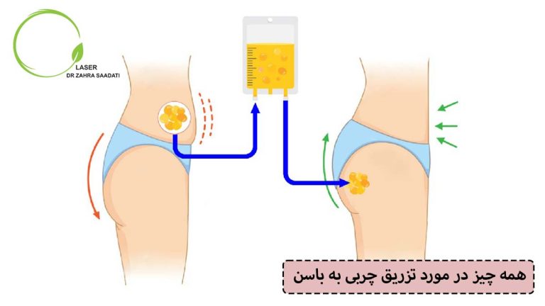 همه چیز در مورد تزریق چربی به باسن آمپول به پشت بانوان