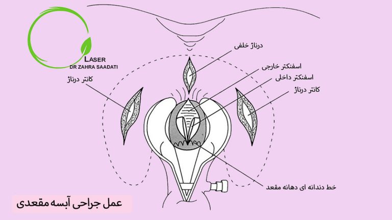 عمل جراحی آبسه مقعدی