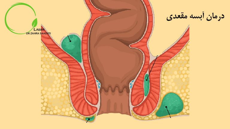 درمان آبسه مقعدی