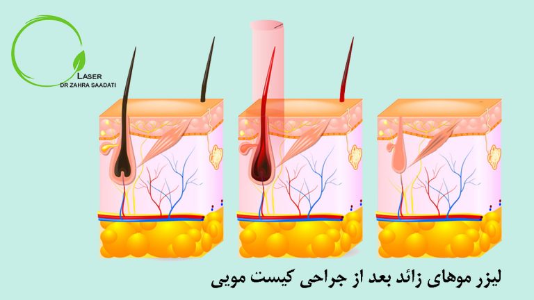 لیزر موهای زائد بعد از جراحی کیست مویی