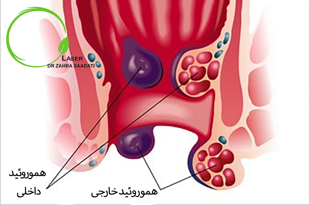 التهاب و ورم مقعدی به دلیل هموروئید داخلی و هموروئید خارجی