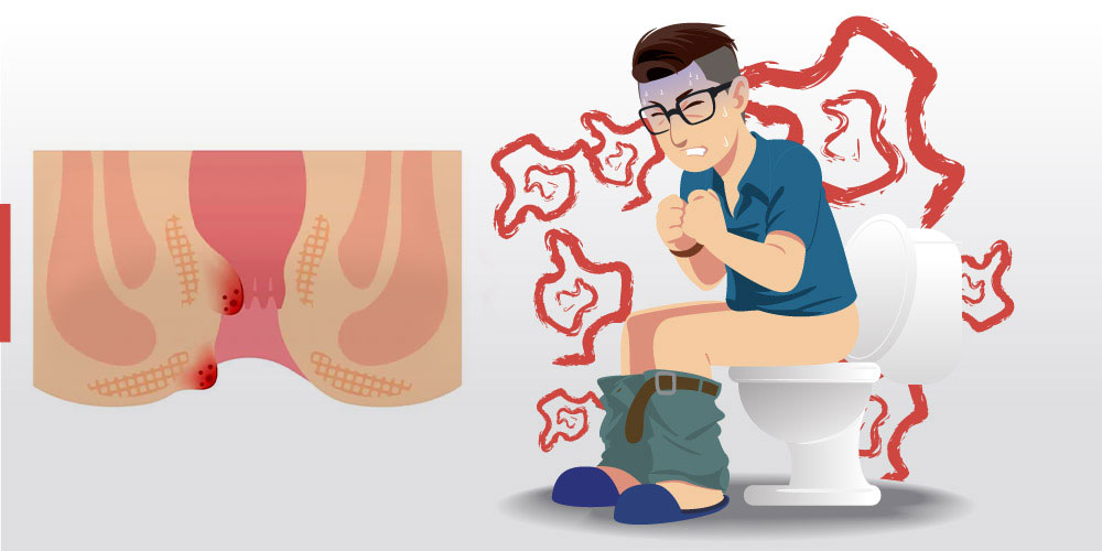 آقایی که هنگام دفع مدفوع از درد مقعدی ناشی از هموروئید و شقاق رنج می برد