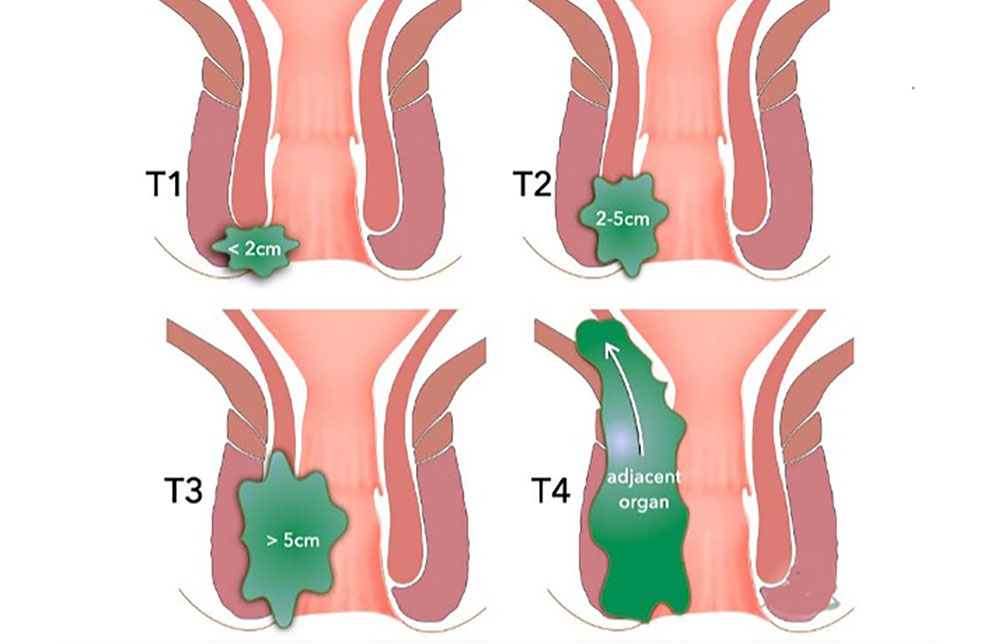 سرطان مقعد یا کلورکتال کنسر در ۴ مرحله