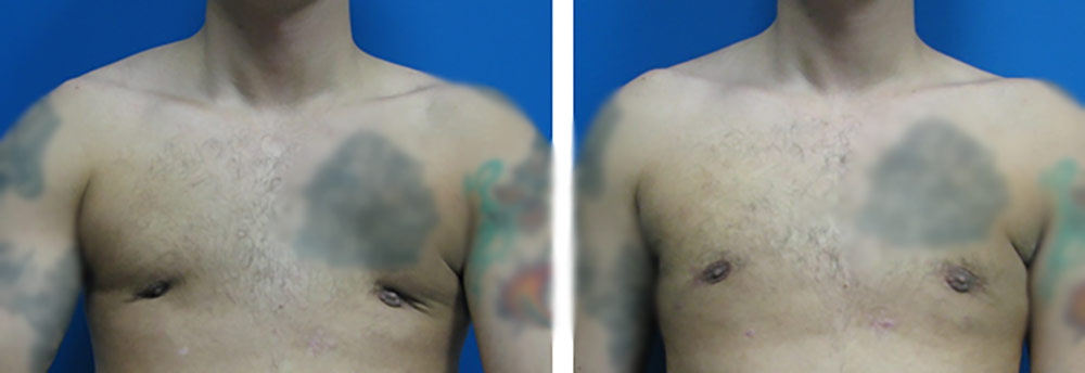 قبل و بعد جراحی نوک سینه فرورفته مردان