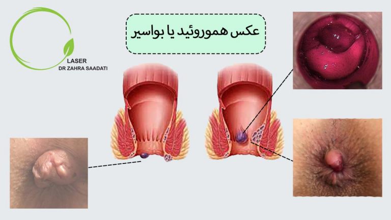 عکس هموروئید یا بواسیر