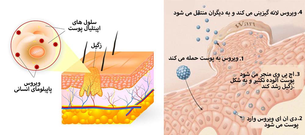 انتقال زگیل تناسلی بدون علائم