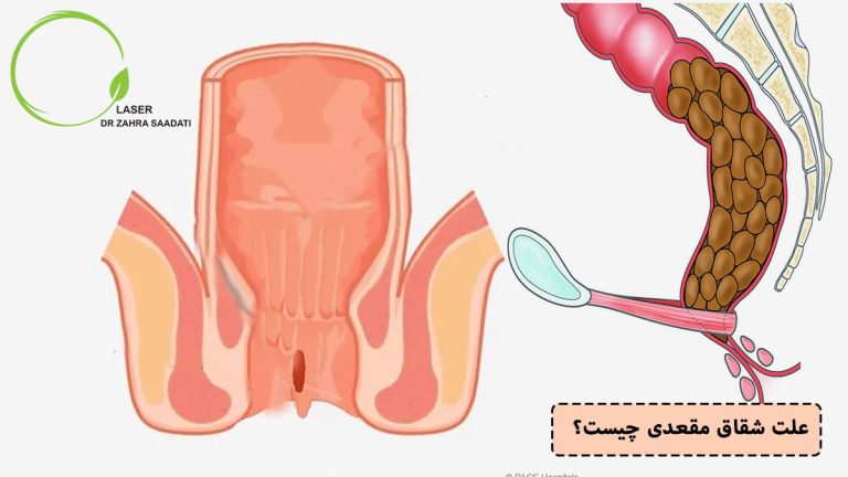 علت شقاق مقعدی چیست