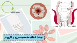 درمان شقاق سریع و کاربردی