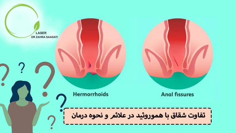 تفاوت هموروئید با شقاق در علائم و نحوه درمان