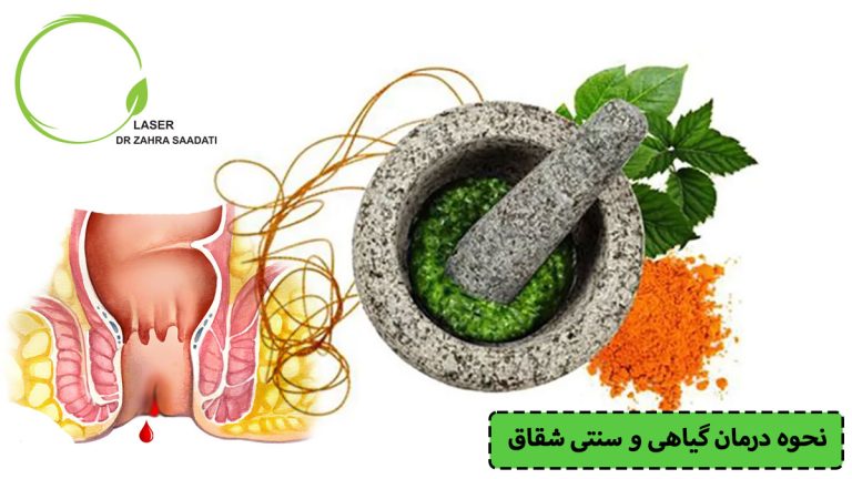 نحوه درمان گیاهی و سنتی شقاق