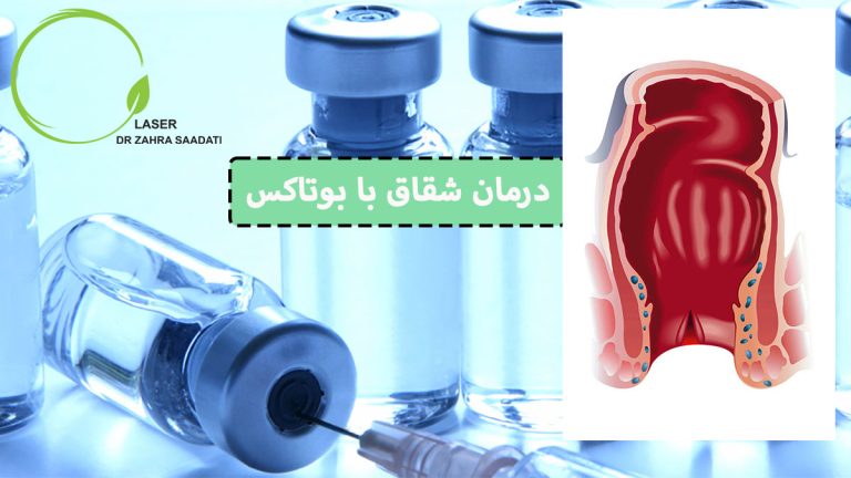 درمان شقاق با بوتاکس